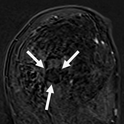 Non-enhancing lesion