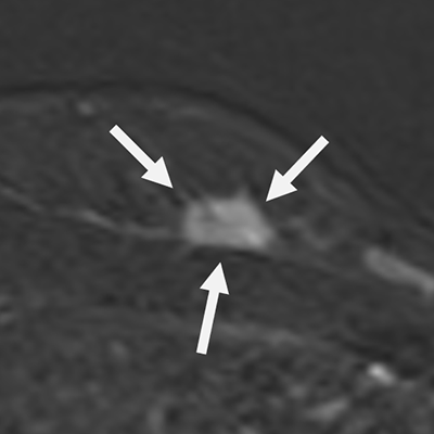 Enhancing lesion
